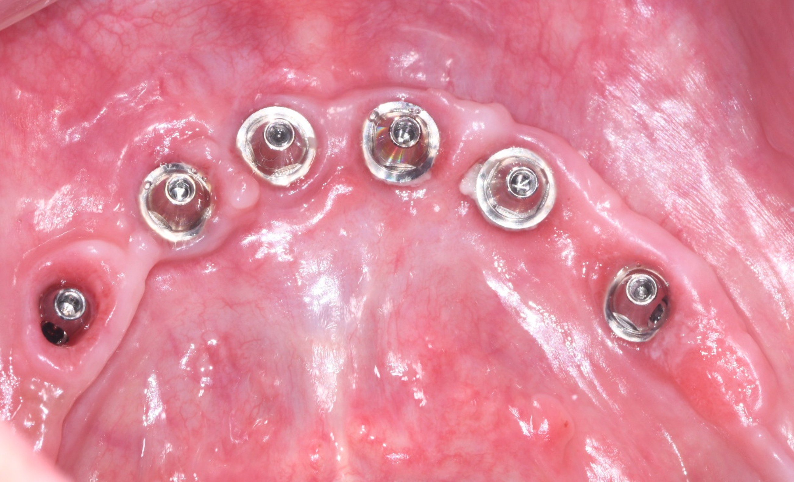 Implants with scan bodies – maxillary