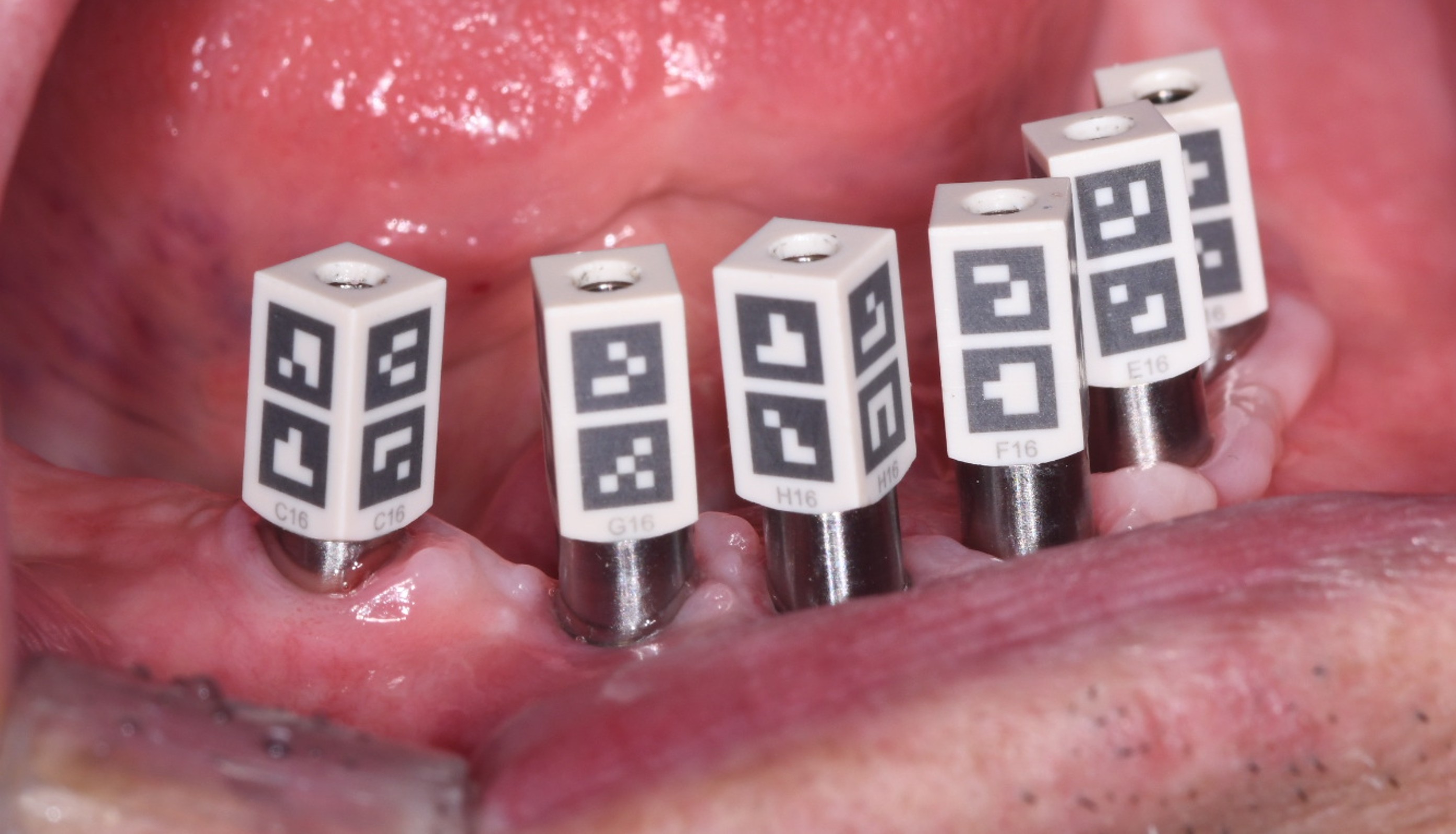 Photogrammetry markers on MUA abutments – mandibular