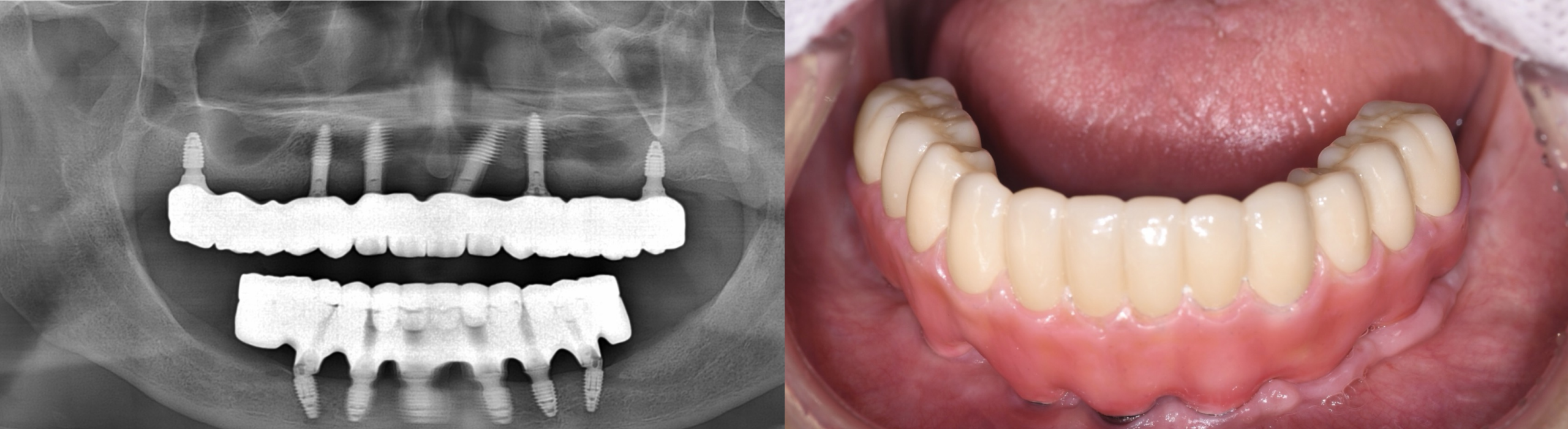 Final full-arch implant restoration